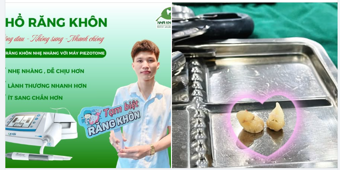 MÙNG 1 SỚM MAI – MÙNG 2 BYE BYE 2 CHIẾC RĂNG KHÔN