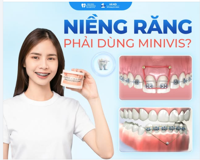 MINIVIS NIỀNG RĂNG LÀ GÌ? VÌ SAO NHIỀU CA CHỈNH NHA CẦN ĐẾN?