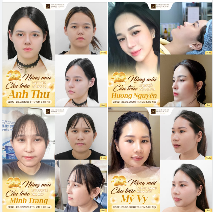 NÂNG MŨI ĐÓN VẬN MAY CÁT TƯỜNG  GIẢM NGAY 20% các DV Nâng mũi