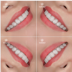 RĂNG SỨ LAVA 3M - LỰA CHỌN TINH TẾ CHO NỤ CƯỜI HOÀN MỸ