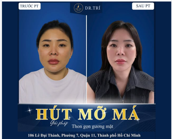 HÚT MỠ MÁ – MẶT THON GỌN, TRẺ HÓA TỨC THÌ!