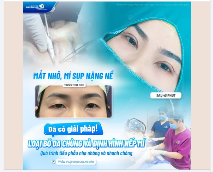 MẮT NHỎ, MÍ SỤP NẶNG NỀ – ĐÃ CÓ GIẢI PHÁP