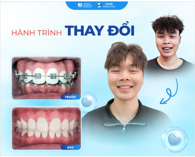 TỪ RĂNG KHẤP KHỂNH ĐẾN NỤ CƯỜI TỰ TIN