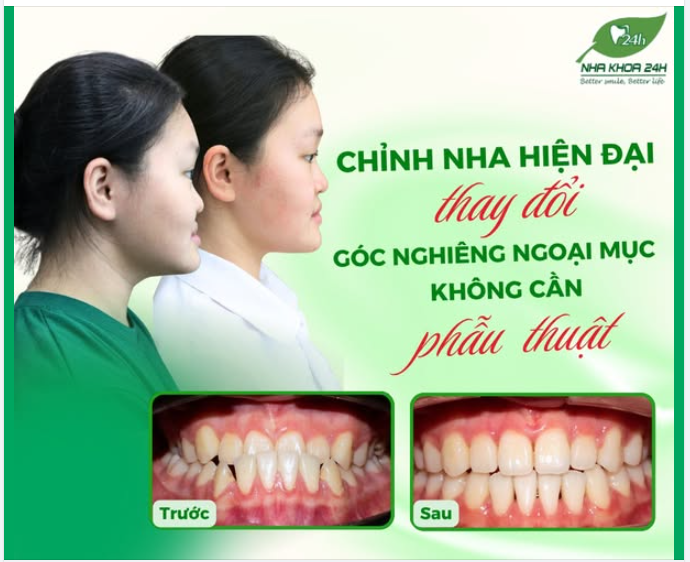 CHỈNH NHA HIỆN ĐẠI – THAY ĐỔI GÓC NGHIÊNG NGOẠI MỤC KHÔNG CẦN PHẪU THUẬT