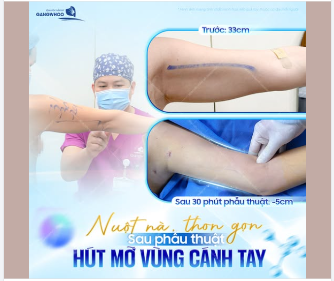 NUỘT NÀ, THON GỌN – THAY ĐỔI NHẸ NHÀNG Ở VÙNG CÁNH TAY