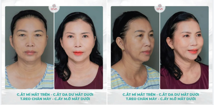 THAY ĐỔI THẦN THÁI KHUÔN MẶT NHỜ SỰ "ĐỔI THAY" VÙNG MẮT