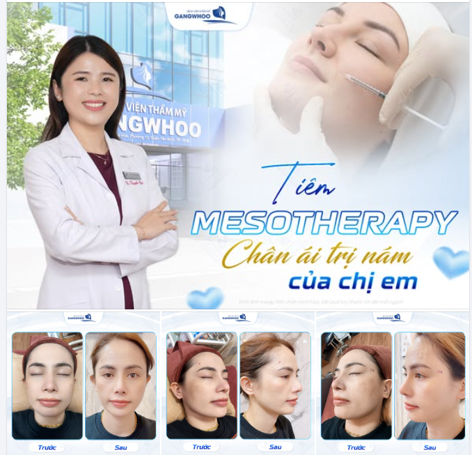 TIÊM MESOTHERAPY – LỰA CHỌN CHO LÀN DA NÁM, KHÔNG ĐỀU MÀU