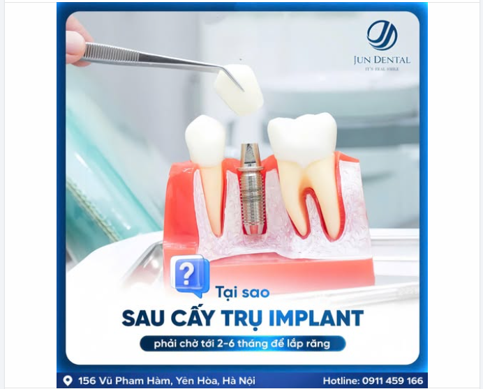 VÌ SAO SAU KHI CẤY TRỤ IMPLANT PHẢI CHỜ 2–6 THÁNG MỚI LẮP RĂNG?