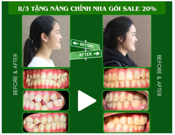 NIỀNG RĂNG – NỤ CƯỜI LÊN HẠNG- NHAN SẮC LÊN ĐỜI