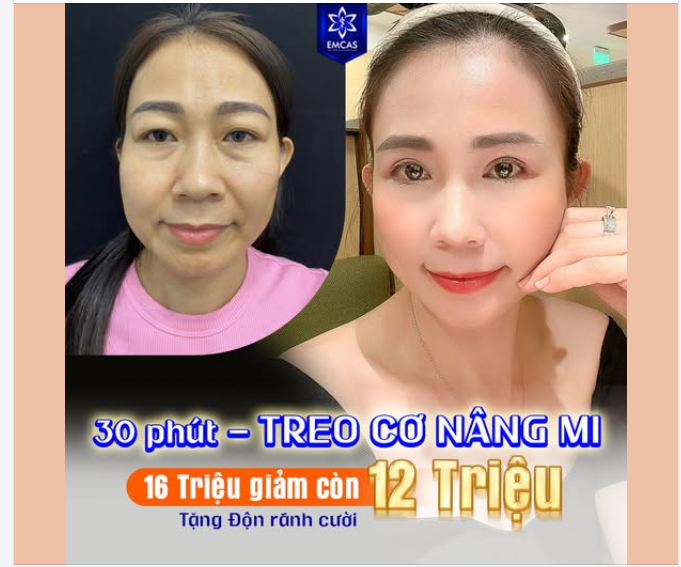 Vỏn vẹn 30 phút để khắc phục mí sụp, xóa mắt một mí, cải thiện mí lót.