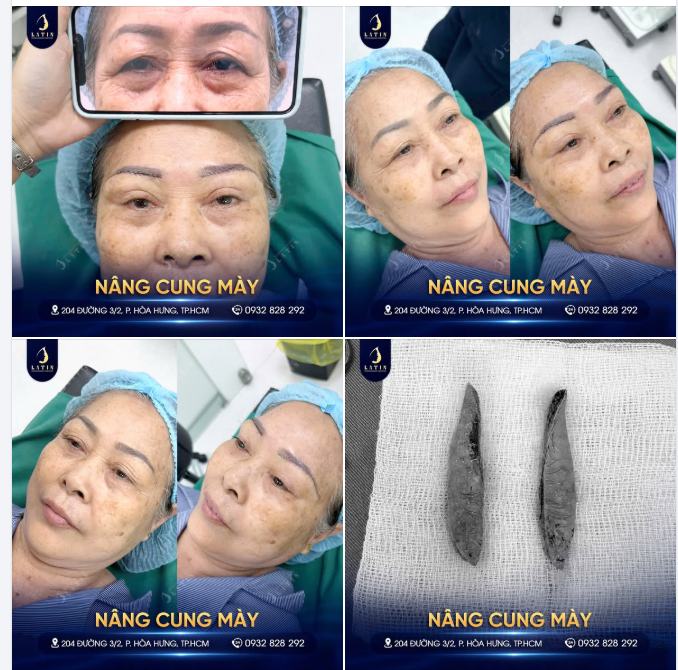 TRẺ HÓA ÁNH NHÌN – TẠM BIỆT MÍ SỤP