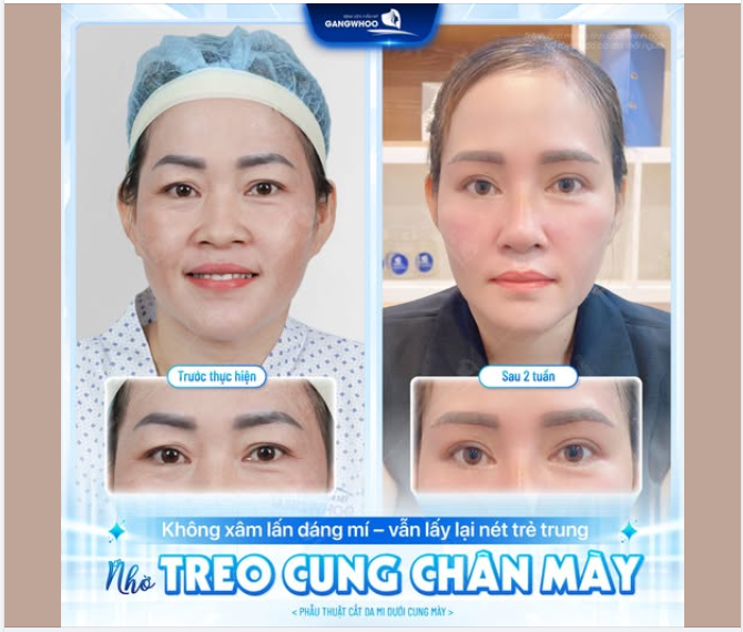 KHÔNG XÂM LẤN DÁNG MÍ – VẪN LẤY LẠI NÉT TRẺ TRUNG