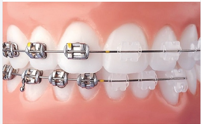 NIỀNG RĂNG MẮC CÀI KIM LOẠI HAY MẮC CÀI SỨ – NÊN CHỌN LOẠI NÀO?