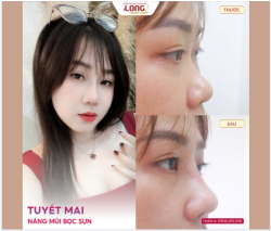 NÂNG MŨI CÓ ĐAU KHÔNG?  CÂU TRẢ LỜI BẤT NGỜ TỪ KHÁCH HÀNG SAU KHI LÀM MŨI