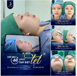 NÂNG MŨI KHÔNG CHỈ LÀM ĐẸP  CÒN LÀ HÀNH TRÌNH YÊU BẢN THÂN