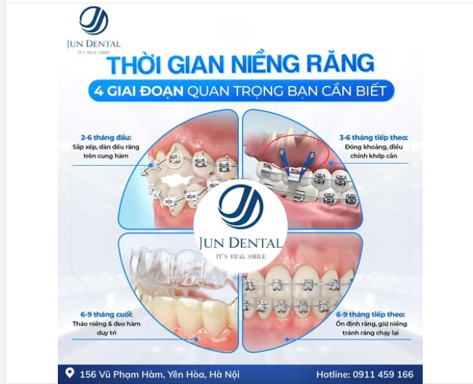 NIỀNG RĂNG MẤT BAO LÂU? 4 GIAI ĐOẠN QUAN TRỌNG TRONG CHỈNH NHA