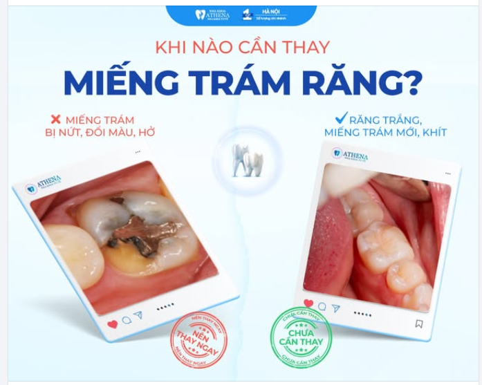 RĂNG ĐÃ TRÁM – CÓ CẦN TRÁM LẠI KHÔNG?