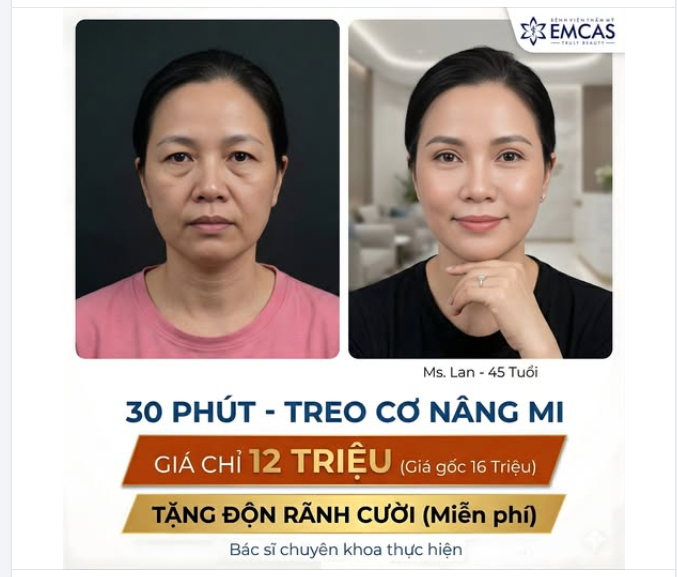 Hack tuổi hiệu quả, giá siêu hời với Treo cơ nâng mi