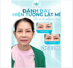 Mí hỏng, lật mi chưa đẹp? Đầu năm sửa lại ngay – còn được SALE 20% mừng khai trương!