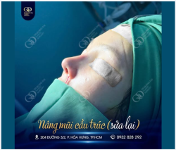 NÂNG MŨI RỒI VẪN CHƯA ĐẸP – LỖI Ở ĐÂU?