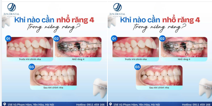 KHI NÀO CẦN NHỔ RĂNG SỐ 4 KHI NIỀNG RĂNG?