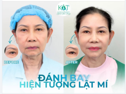 LẬT MÍ DƯỚI – NỖI ÁM ẢNH KHÔNG CHỈ LÀ THẨM MỸ, MÀ CÒN LÀ SỨC KHỎE ĐÔI MẮT