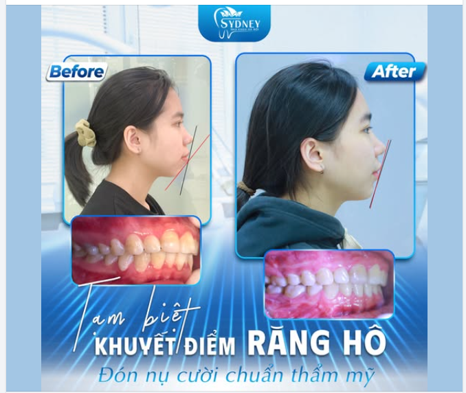 TẠM BIỆT KHUYẾT ĐIỂM RĂNG HÔ - ĐÓN NỤ CƯỜI CHUẨN THẨM MỸ