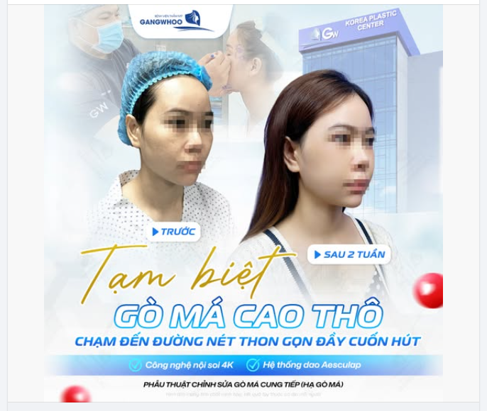 Gò má cao, thô cứng hay hốc hác không chỉ là khuyết điểm về nhân trắc học mà còn vô tình khiến thần thái trở nên sắc sảo quá mức, thiếu đi sự nữ tính và nét hài hòa cần thiết.