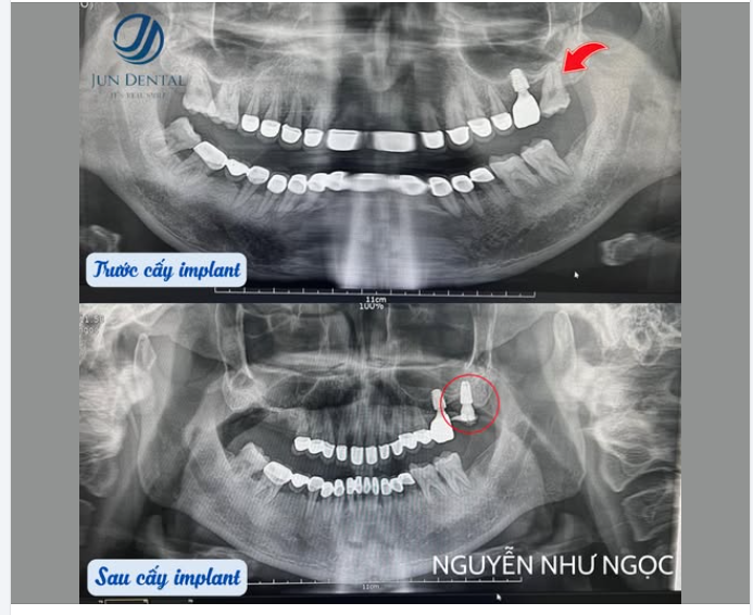 Nhổ – cấy implant tức thì r27 kết hợp xử lý viêm vùng răng 16–17