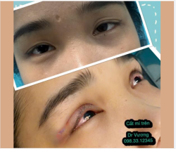 Từ thứ 2-3-4 (ngày 2-3-4/3/2026) Bác sĩ Vương có lịch mổ ưu đãi tại SG nhé các bạn quan tâm !