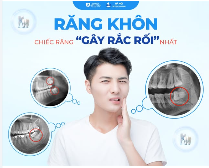 VÌ SAO RĂNG KHÔN LẠI LÀ CHIẾC RĂNG “GÂY RẮC RỐI” NHẤT?