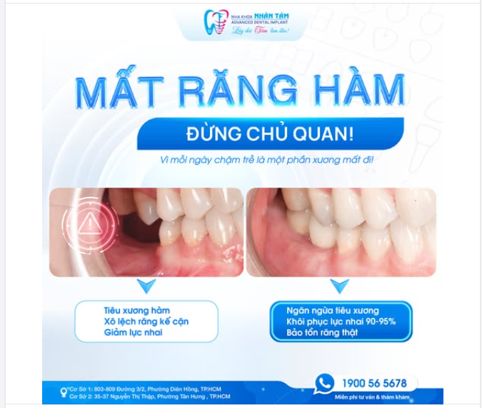 MẤT RĂNG HÀM – ĐỪNG CHỦ QUAN!