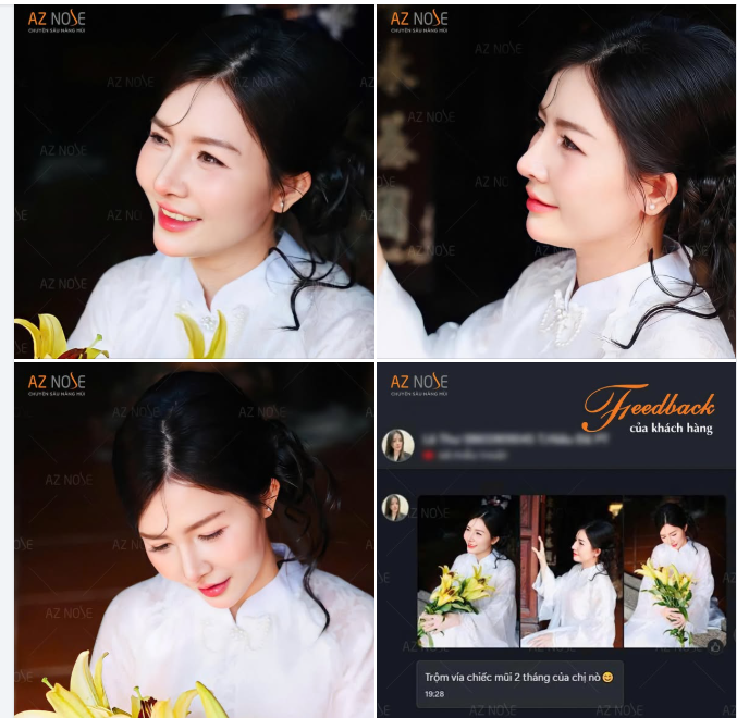 Từng nâng mũi chỉ nhưng kết quả không như mong muốn, chị M.T. quyết định thực hiện nâng mũi cấu trúc và đây là diện mạo sau 2 tháng.