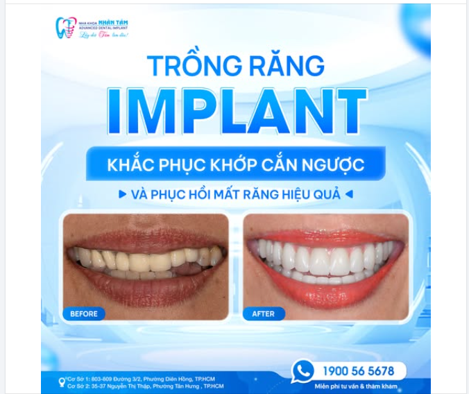 MẤT RĂNG LÂU NĂM  KHỚP CẮN NGƯỢC – MÓM, LỆCH MẶT  GIẢI PHÁP PHỤC HỒI TOÀN DIỆN BẰNG IMPLANT