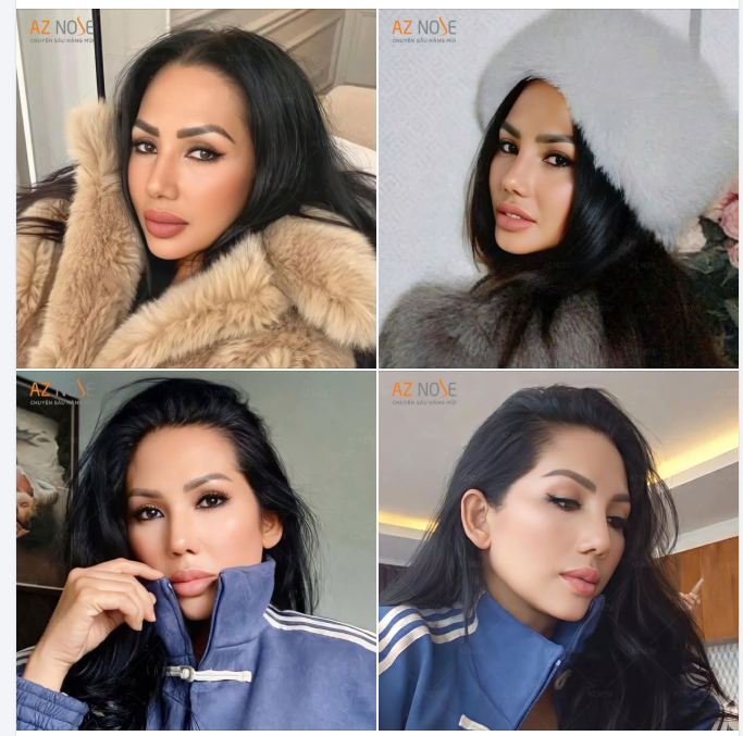 Khắc phục mũi lệch sóng, lộ sụn cho khách hàng đến từ Indonesia