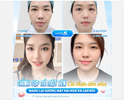 CHỈNH SỤP MÍ MỘT BÊN - CẢI THIỆN TẦM NHÌN