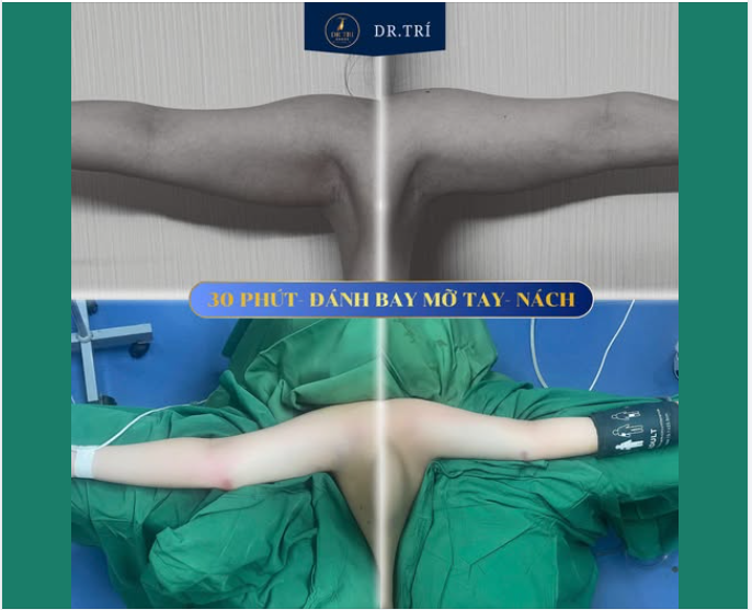 BẮP TAY THON GỌN CHỈ SAU 30 PHÚT