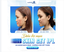 CÔNG NGHỆ SKIN GET IPL  Da nàng sạch mụn, chẳng còn vết thâm