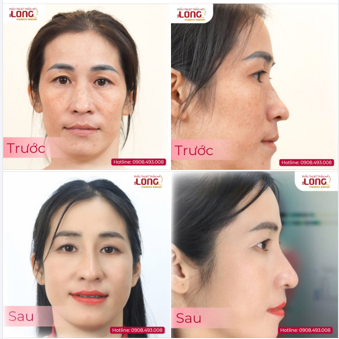 KHÔNG THÍCH “PT” NHƯNG VẪN MUỐN ĐẸP  SAO MÀ LÀM  CHUYỆN NHỎ