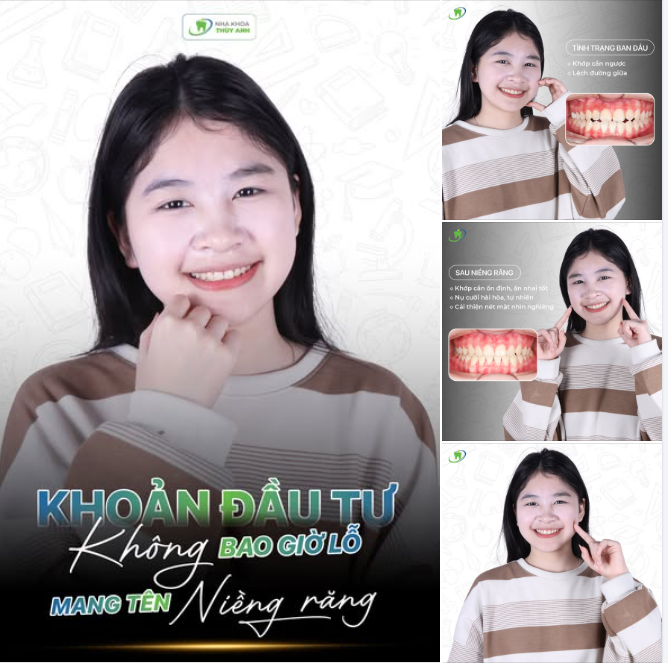 KẾT QUẢ NIỀNG RĂNG CHỈNH CẮN NGƯỢC CHO BẠN NHỎ CÓ THÓI QUEN ĐẨY LƯỠI, VIÊM LỢI