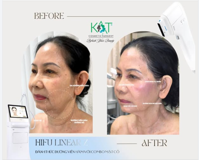 HIFU LINEARZ – Không phải ai cũng cần, nhưng ai làm rồi cũng không muốn quay lại gương mặt cũ.