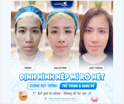 ĐỊNH HÌNH NẾP MÍ RÕ NÉT – GƯƠNG MẶT TRẺ TRUNG