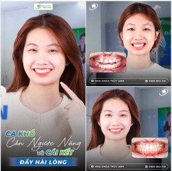 CA KHÓ KHỚP CẮN NGƯỢC, CHEN CHÚC NẶNG KÈM LỆCH MẶT: VỀ ĐÍCH VỚI KẾT QUẢ HÀI LÒNG