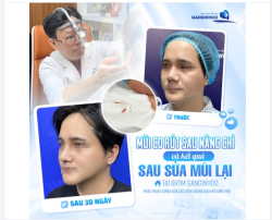 ​​​​​​​ Bạn từng nghĩ "nâng mũi bằng chỉ" là nhanh, rẻ, không cần nghỉ dưỡng? Hãy nhìn vào bức ảnh này