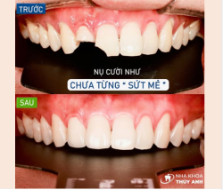NHƯ CHƯA TỪNG CÓ NHỮNG CHIẾC RĂNG SỨT MẺ