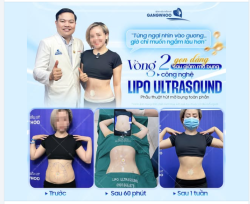 VÒNG 2 GỌN GÀNG Sau giảm mỡ bụng công nghệ Lipo Ultrasound