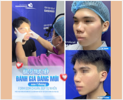 BÁC SĨ TRỰC TIẾP ĐÁNH GIÁ DÁNG MŨI SAU 1 THÁNG