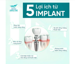 TẠI SAO NÊN CHỌN IMPLANT KHI MẤT RĂNG?
