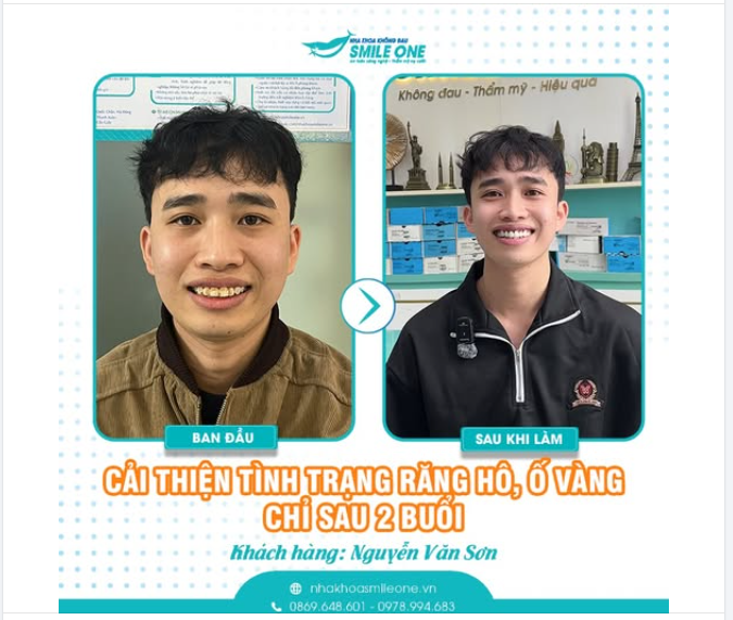 TẠM BIỆT RĂNG HÔ Ố VÀNG CHỈ SAU 2 BUỔI