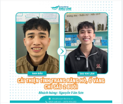 TẠM BIỆT RĂNG HÔ Ố VÀNG CHỈ SAU 2 BUỔI